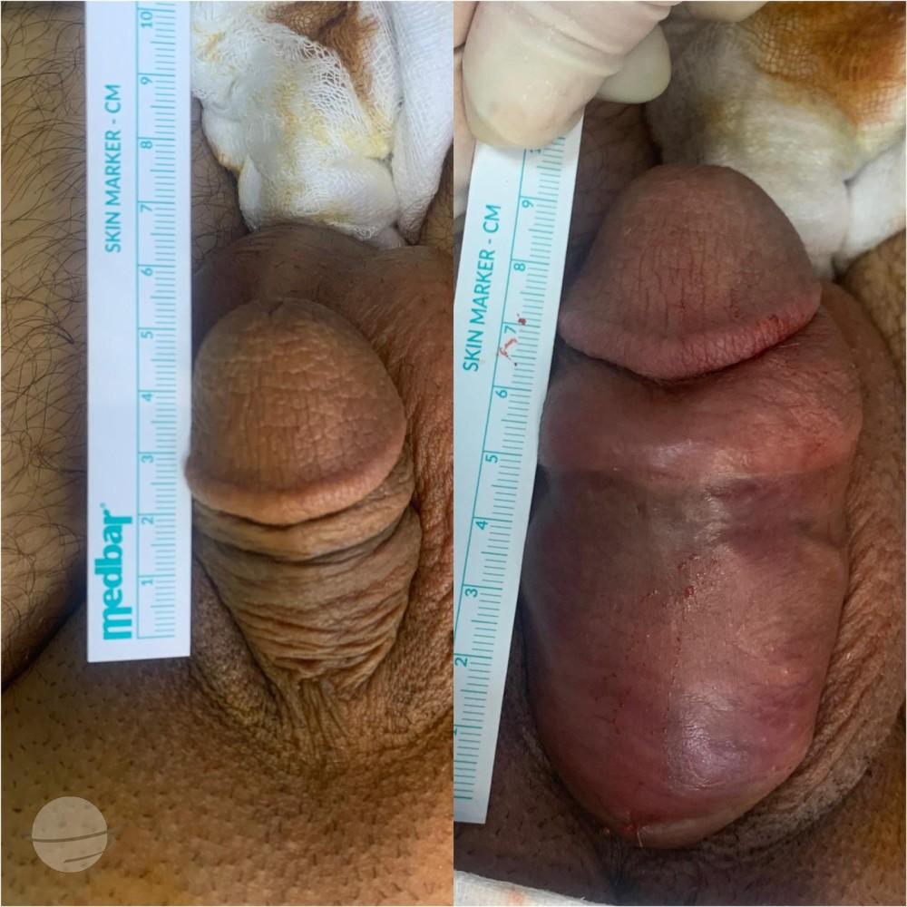 Resultado de antes y después para Penoplastia — Ekol Hastanesi