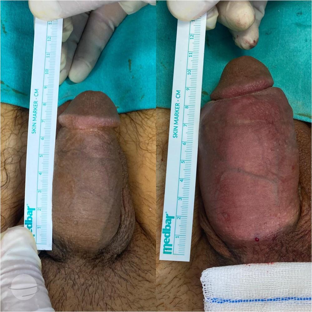 Resultado de antes y después para Penoplastia — Ekol Hastanesi