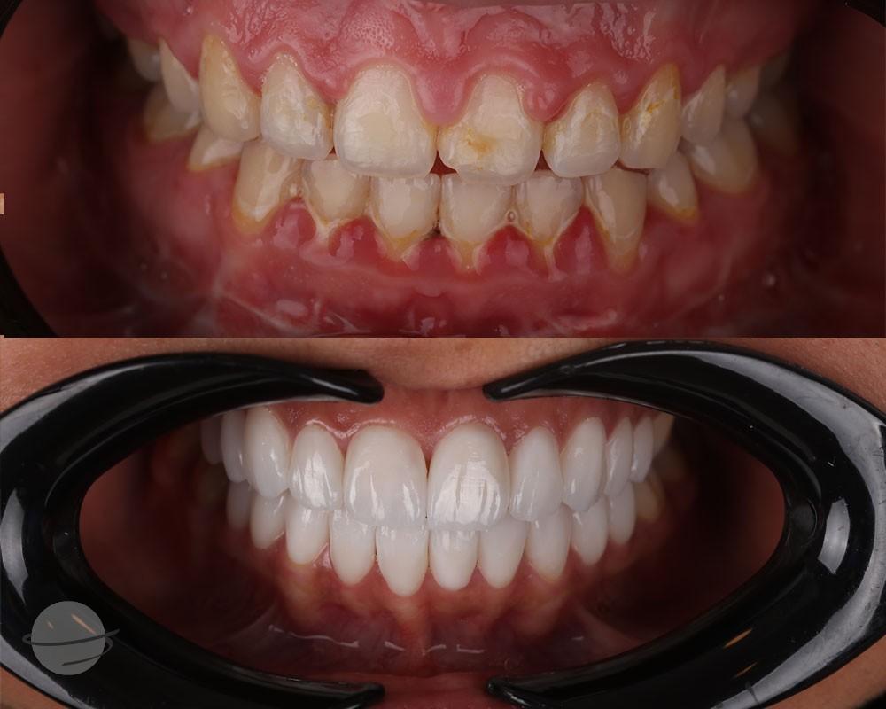 Risultato prima e dopo per Faccette dentali — DXB Esthétique