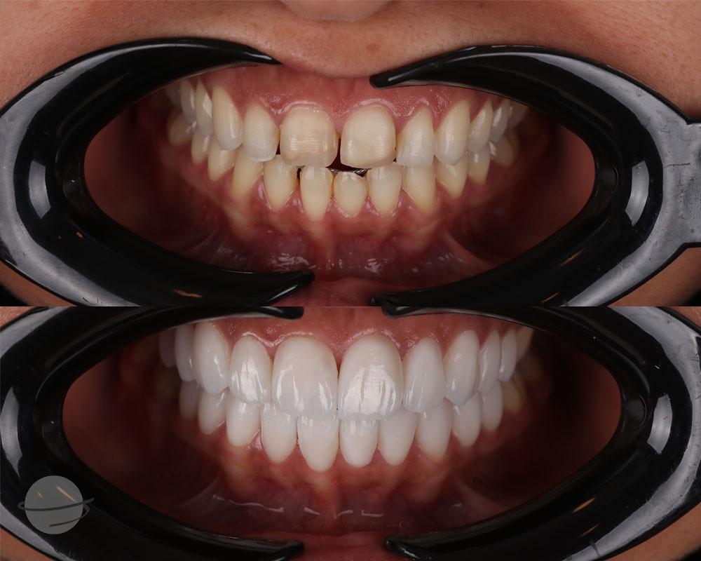 Risultato prima e dopo per Faccette dentali — DXB Esthétique