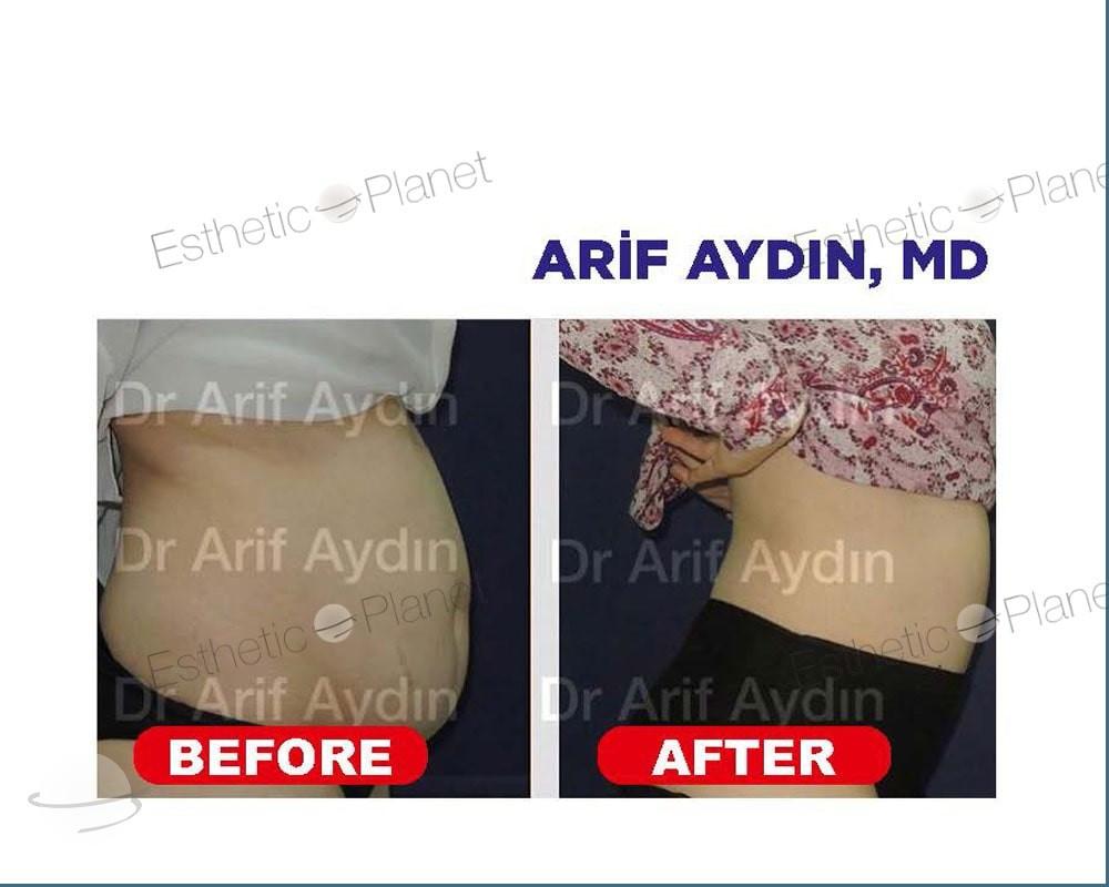 Before and after result for Tummy tuck — Ekol Hastanesi