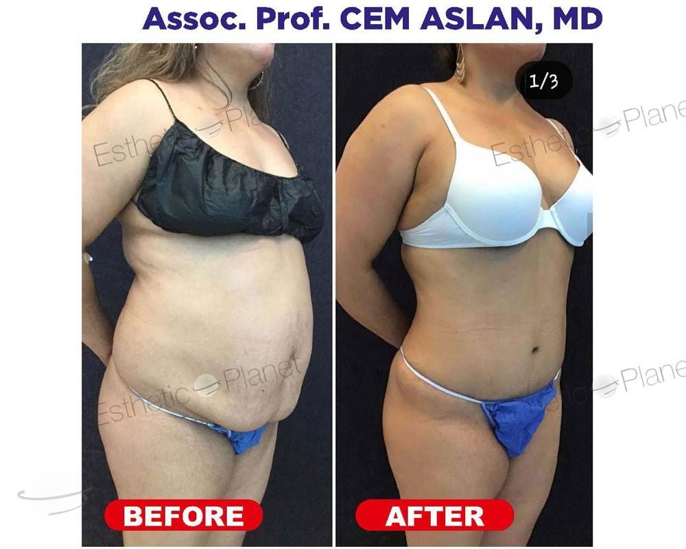 Resultado de antes y después para Abdominoplastia — Ekol Hastanesi