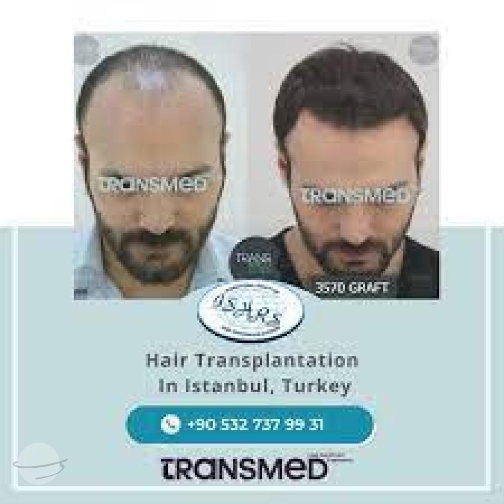 Transmed Hair Clinic result