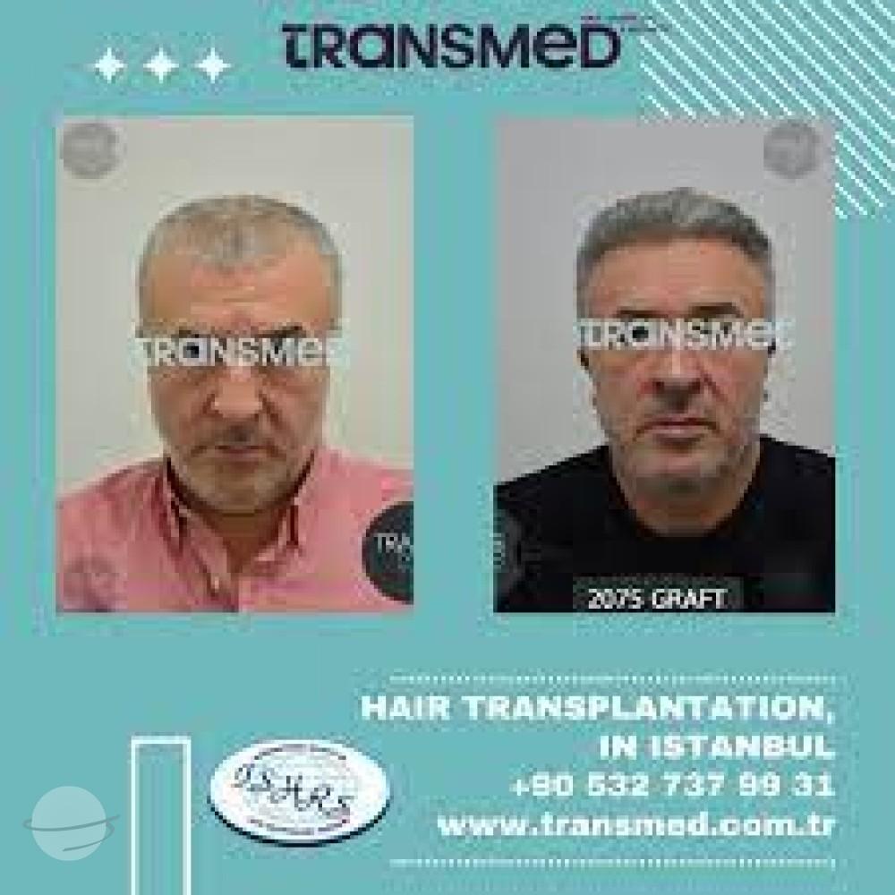Transmed Hair Clinic result