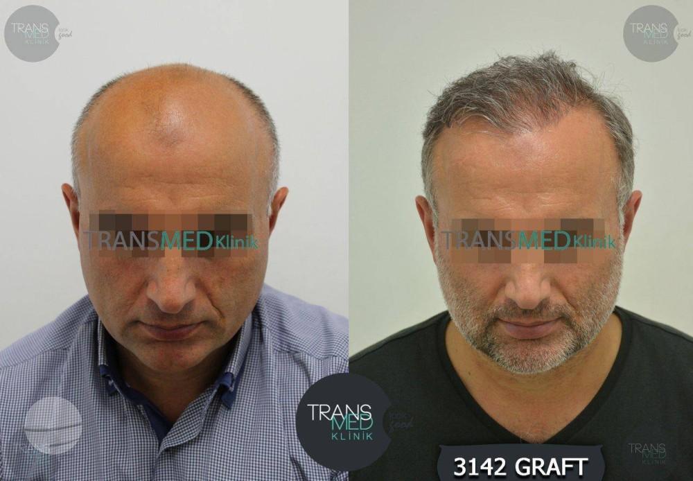 Transmed Hair Clinic result