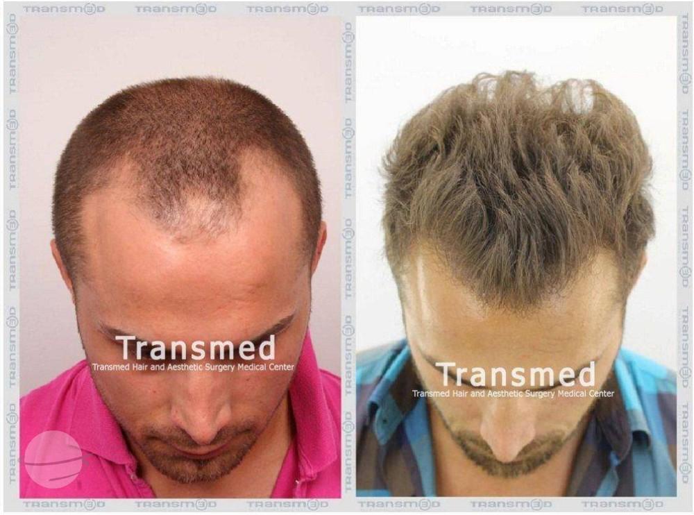 Transmed Hair Clinic result