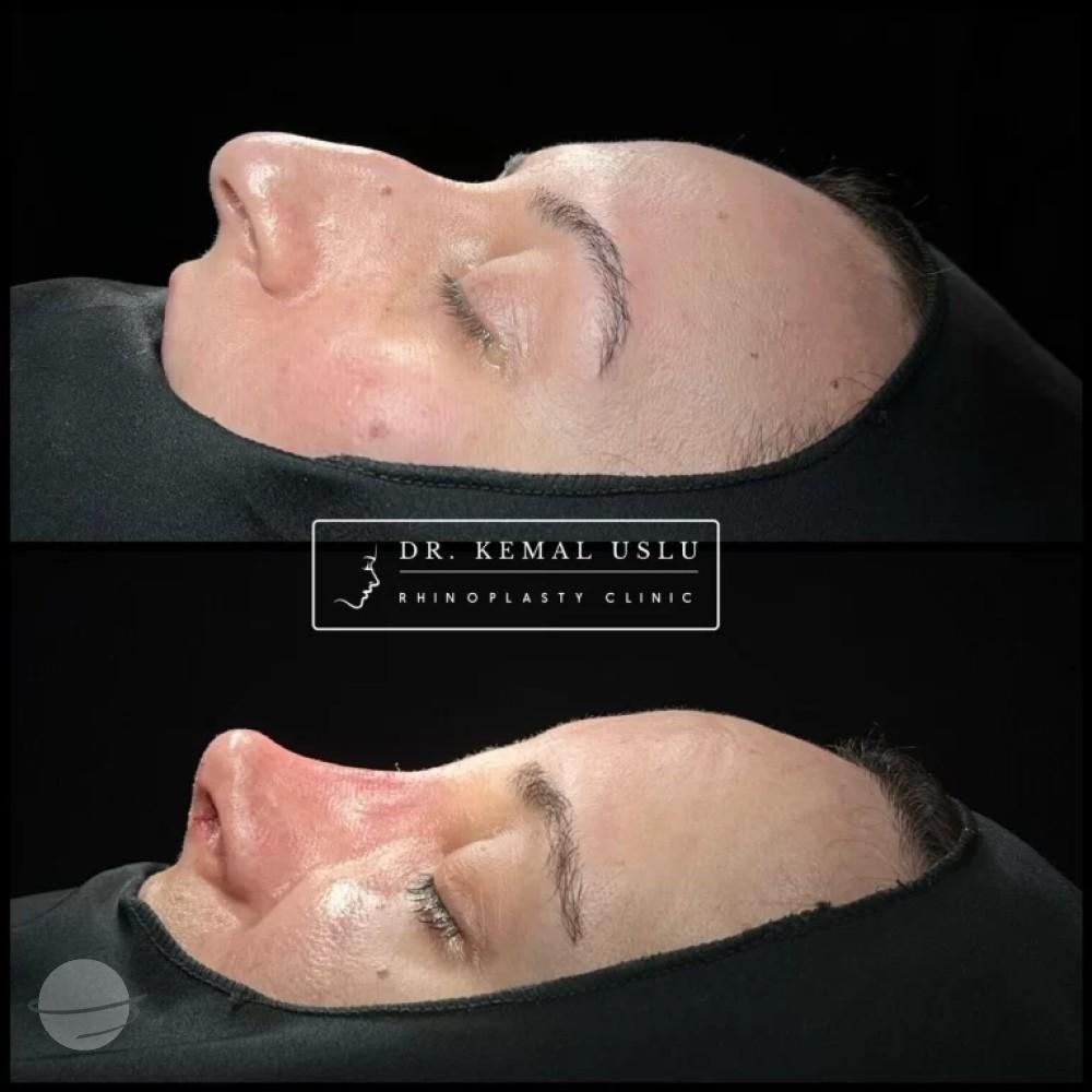 Dr Kemal Uslu Rhinoplasty