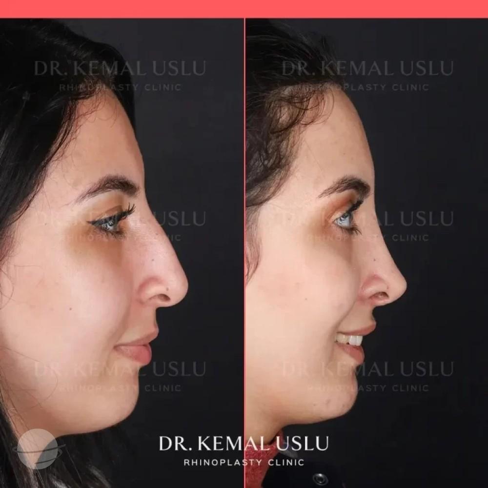 Dr Kemal Uslu Rhinoplasty