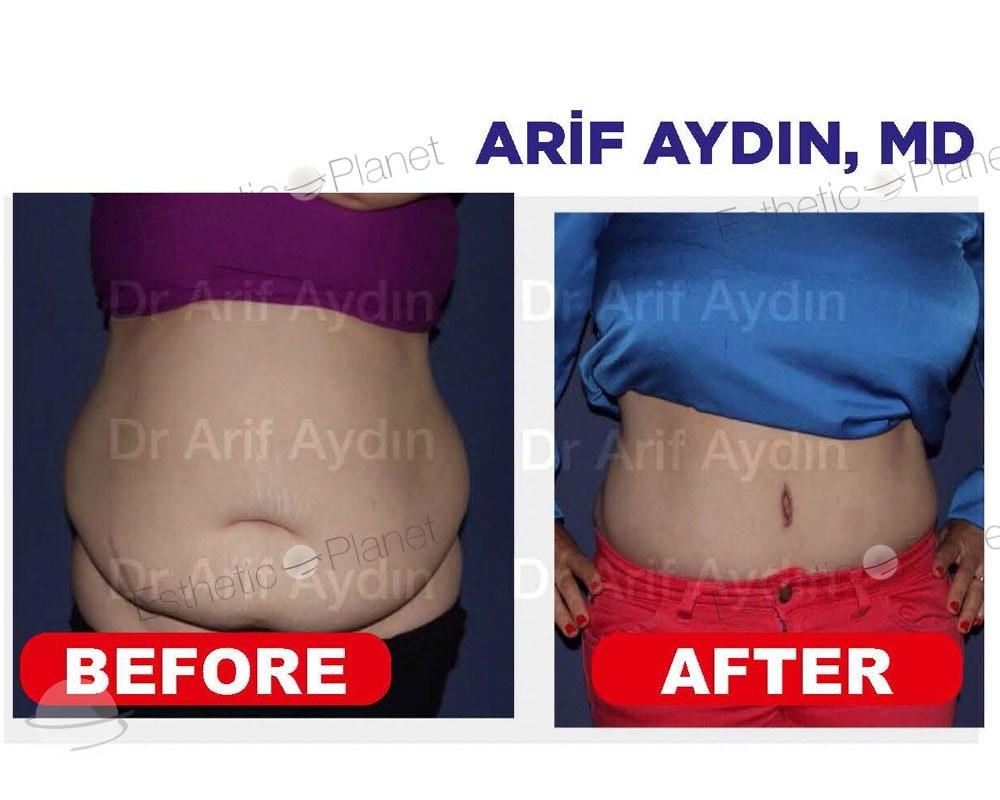 Resultado de antes y después para Abdominoplastia — Ekol Hastanesi