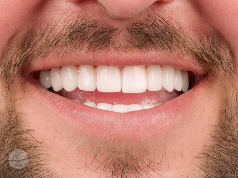 Risultato prima e dopo per Faccette dentali — VIP Smile