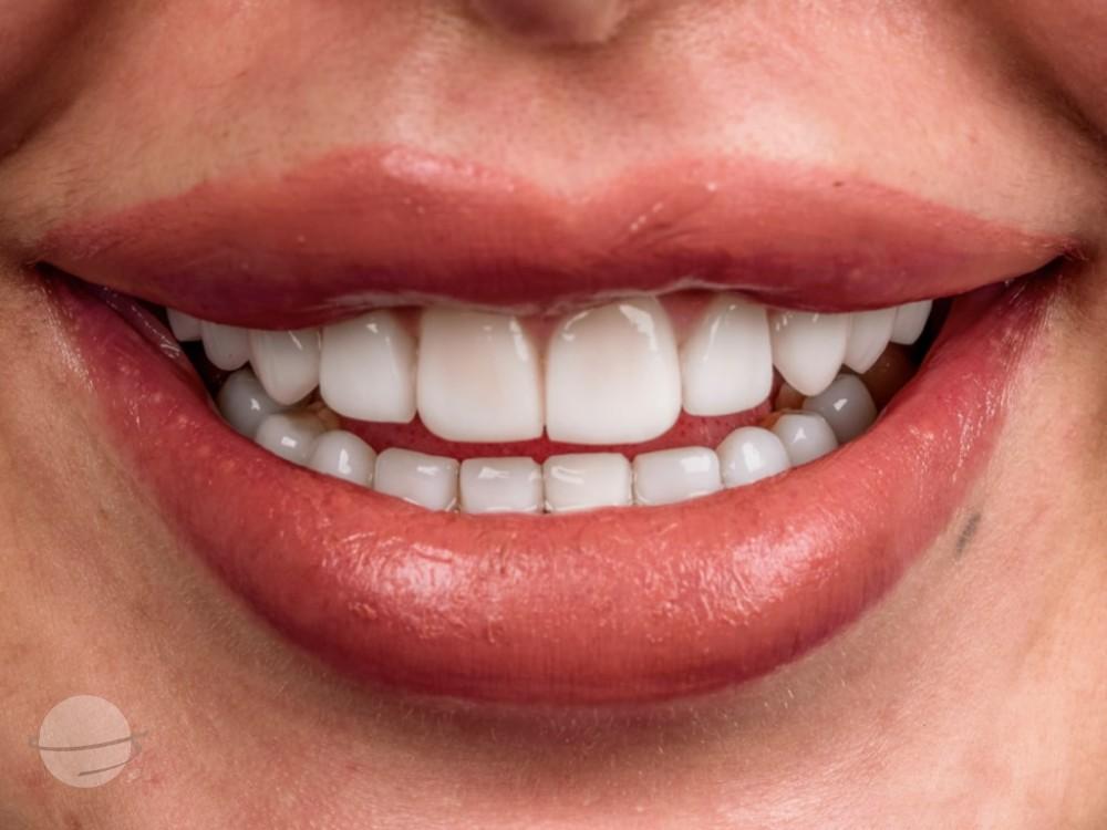 Risultato prima e dopo per Faccette dentali — VIP Smile