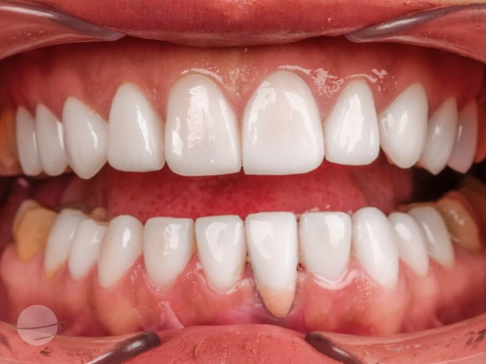 Resultado de antes y después para Carillas dentales — VIP Smile
