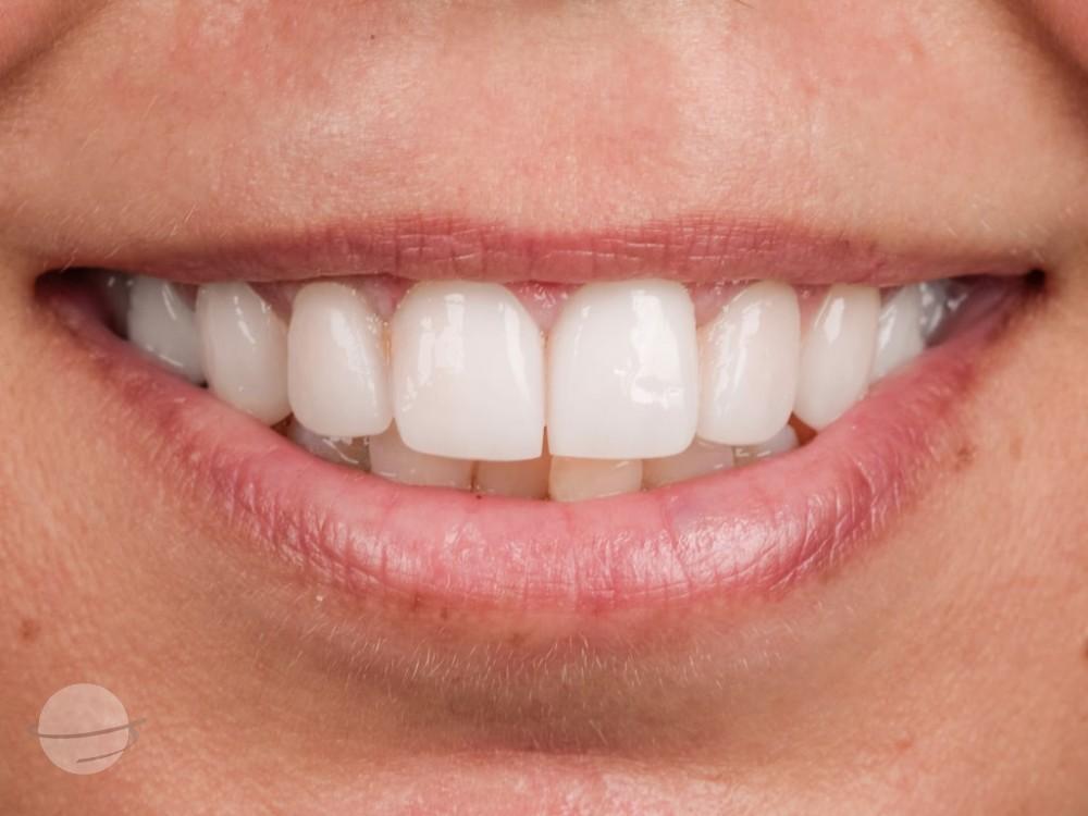Risultato prima e dopo per Faccette dentali — VIP Smile