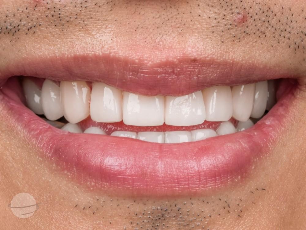 Risultato prima e dopo per Faccette dentali — VIP Smile