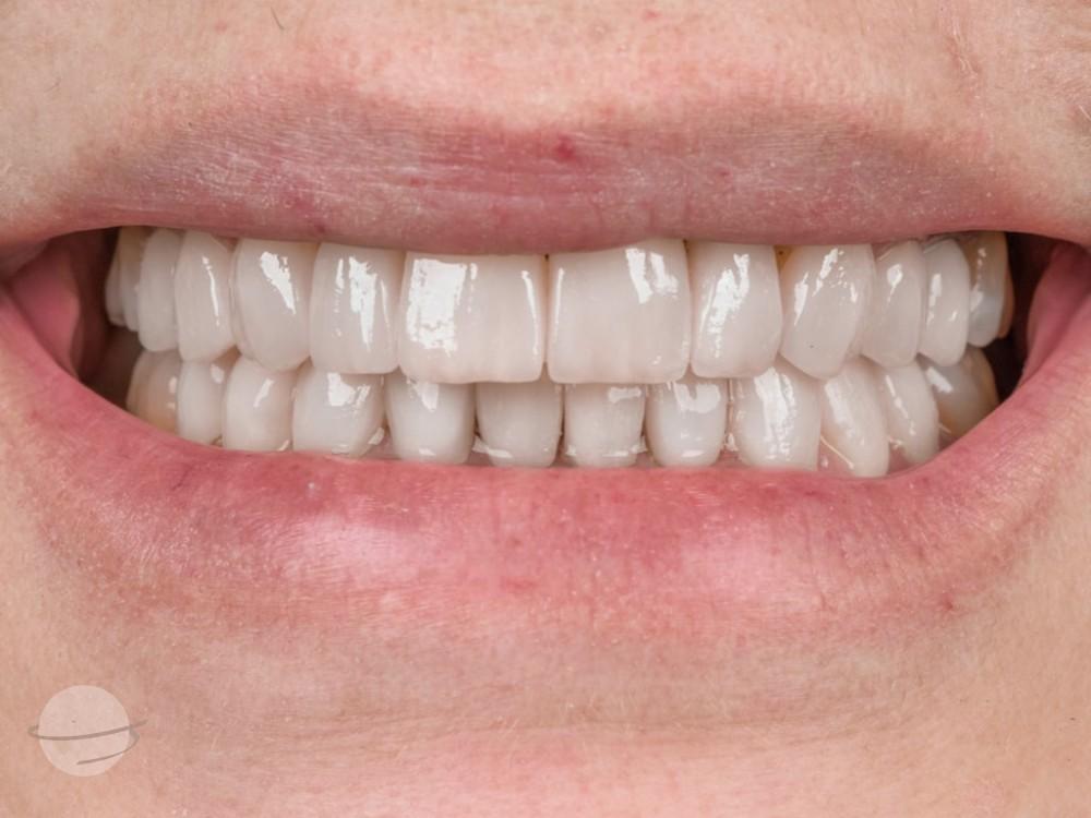 Resultado de antes y después para Coronas dentales — VIP Smile