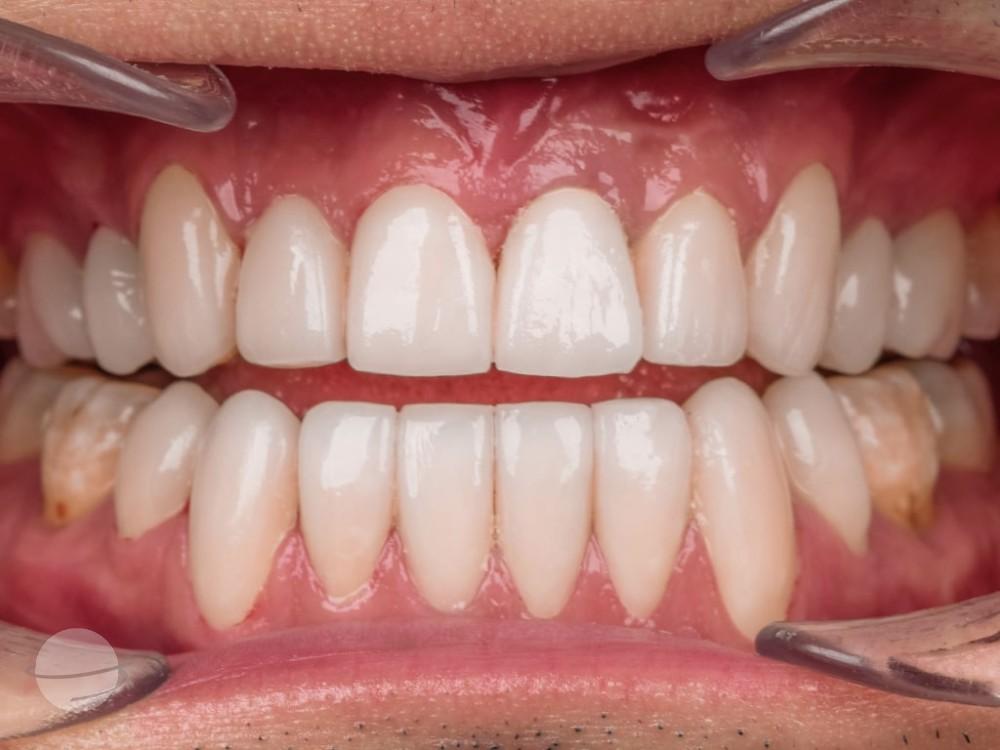 Resultado de antes y después para Coronas dentales — VIP Smile