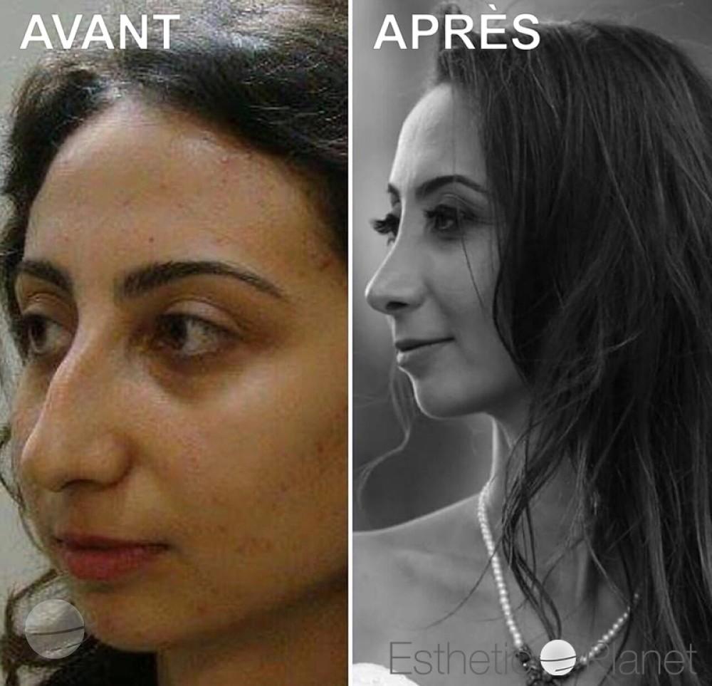 Rhinoplastie