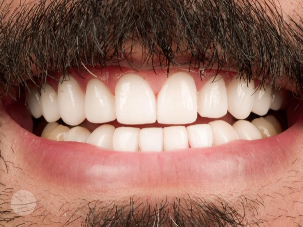 Resultado de antes y después para Coronas dentales — VIP Smile