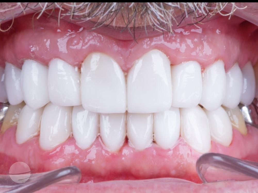 Resultado de antes y después para Coronas dentales — VIP Smile