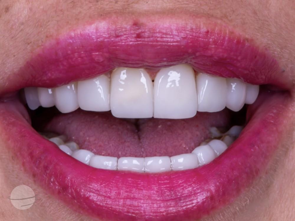 Resultado de antes y después para Coronas dentales — VIP Smile