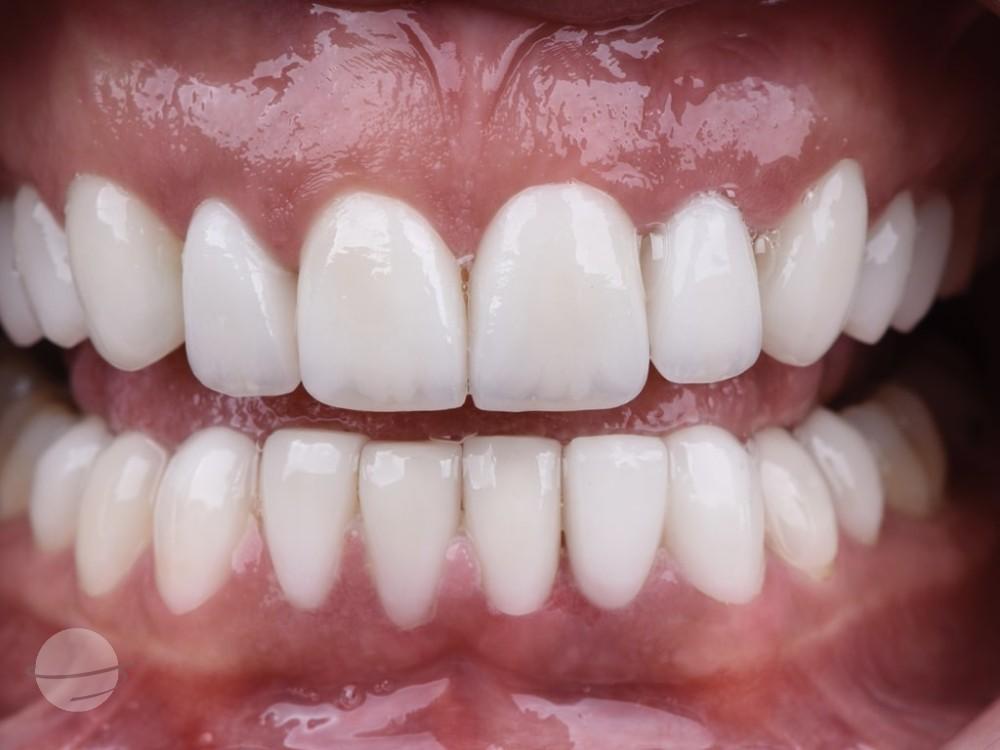 Résultat avant / après pour Couronnes Dentaires — VIP Smile