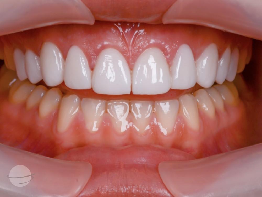 Resultado de antes y después para Coronas dentales — VIP Smile