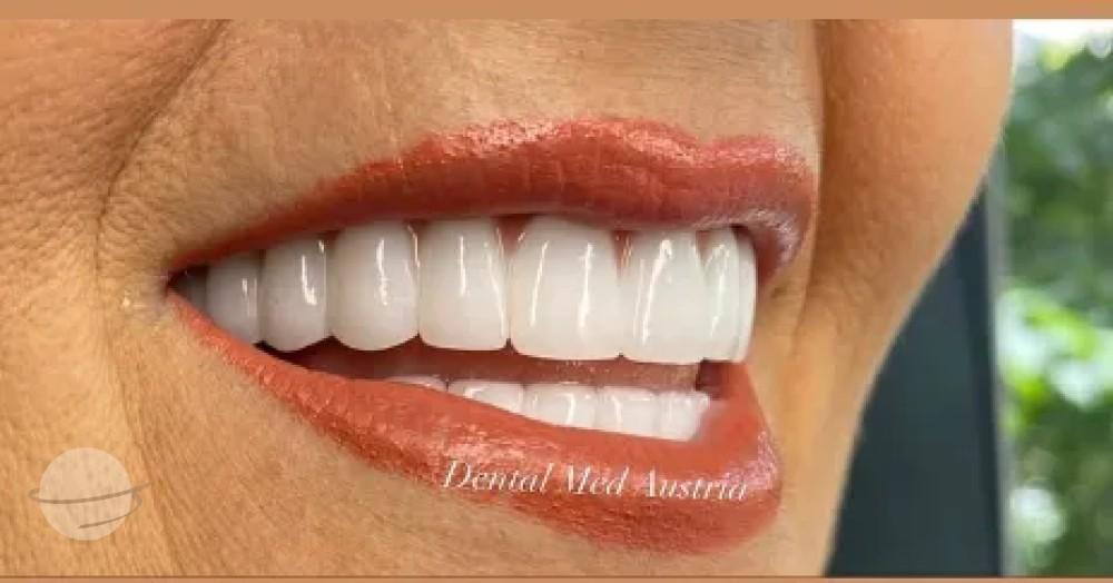Before and after result for Dental crowns — Dental Med Austria