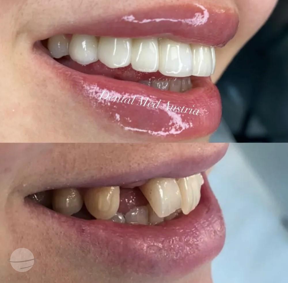 Before and after result for Dental crowns — Dental Med Austria
