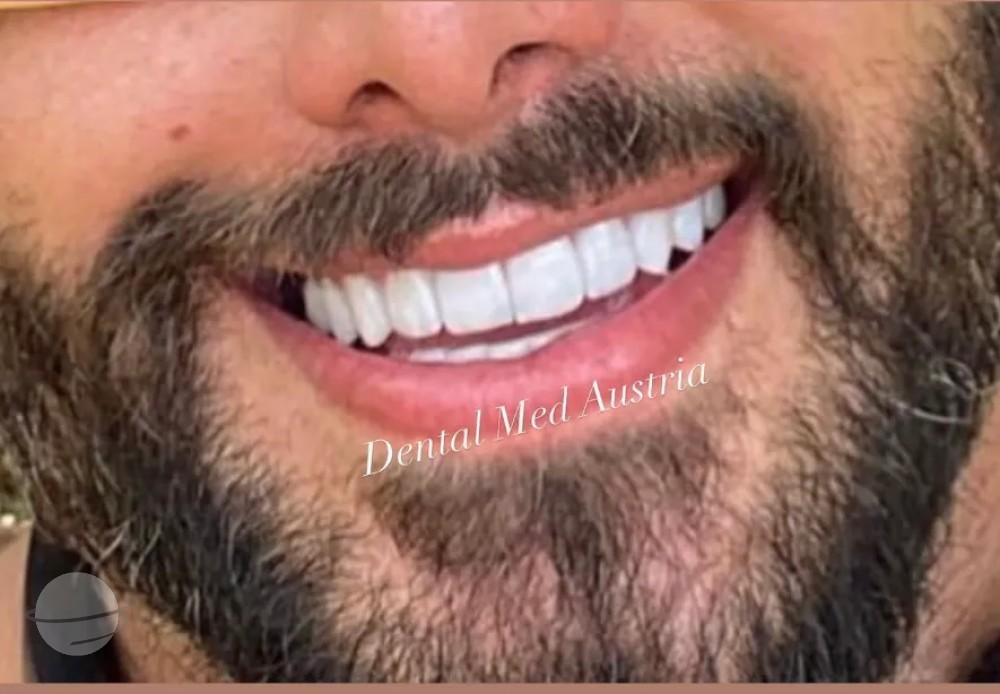 Résultat avant / après pour Couronnes Dentaires — Dental Med Austria