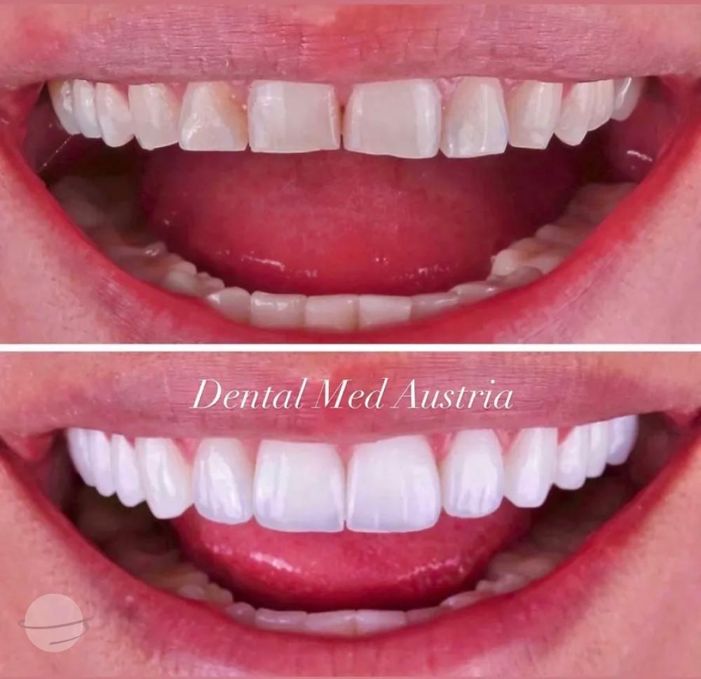 Resultado de antes y después para Coronas dentales — Dental Med Austria
