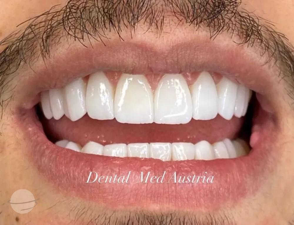 Résultat avant / après pour Couronnes Dentaires — Dental Med Austria
