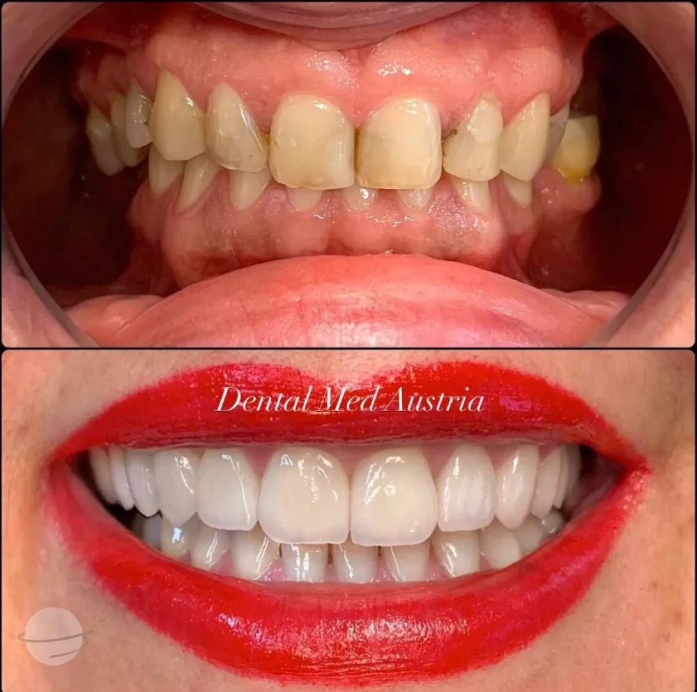 Resultado de antes y después para Coronas dentales — Dental Med Austria