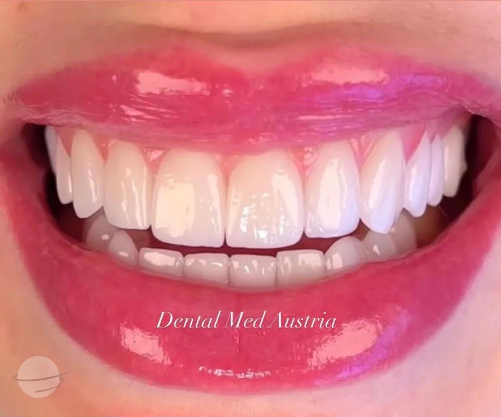 Resultado de antes y después para Coronas dentales — Dental Med Austria