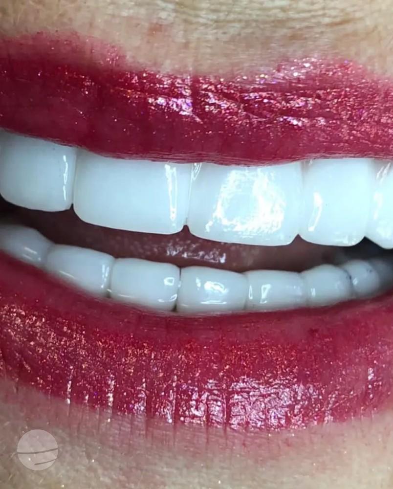 Résultat avant / après pour Couronnes Dentaires — Dental Med Austria