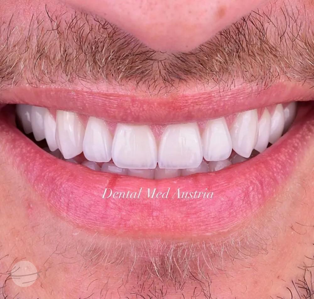 Before and after result for Dental crowns — Dental Med Austria