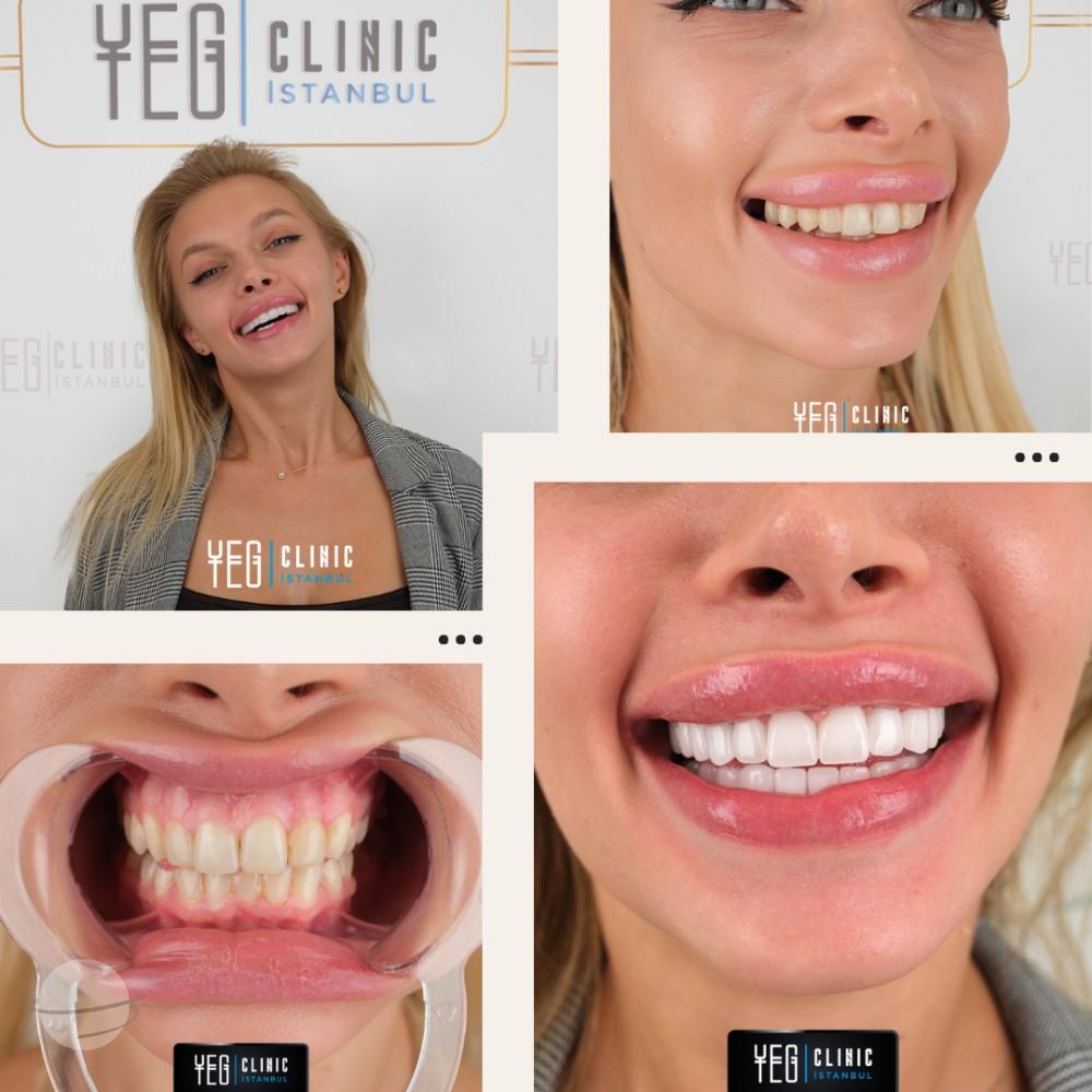Emax Veneers