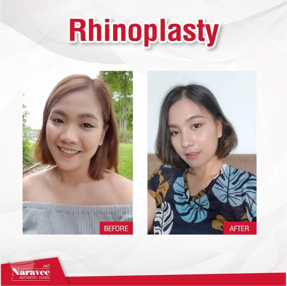 Résultat avant / après pour Rhinoplastie — Naravee Clinic