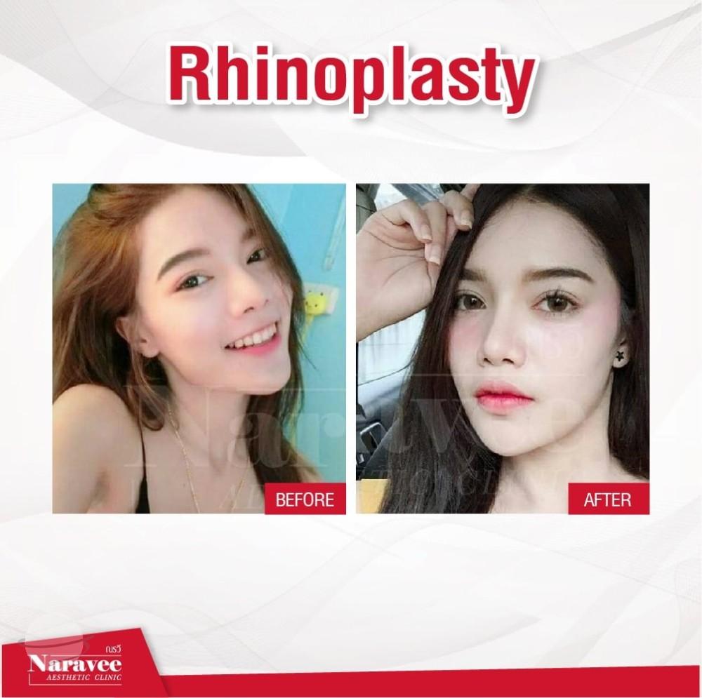 Risultato prima e dopo per Rinoplastica — Naravee Clinic