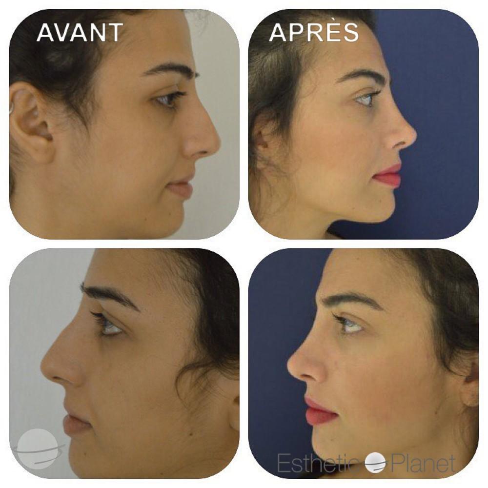 Rhinoplastie by Dr Ergin Er