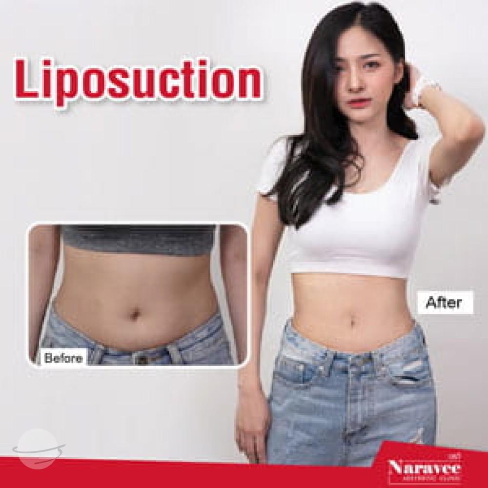 Risultato prima e dopo per Liposuzione — Naravee Clinic