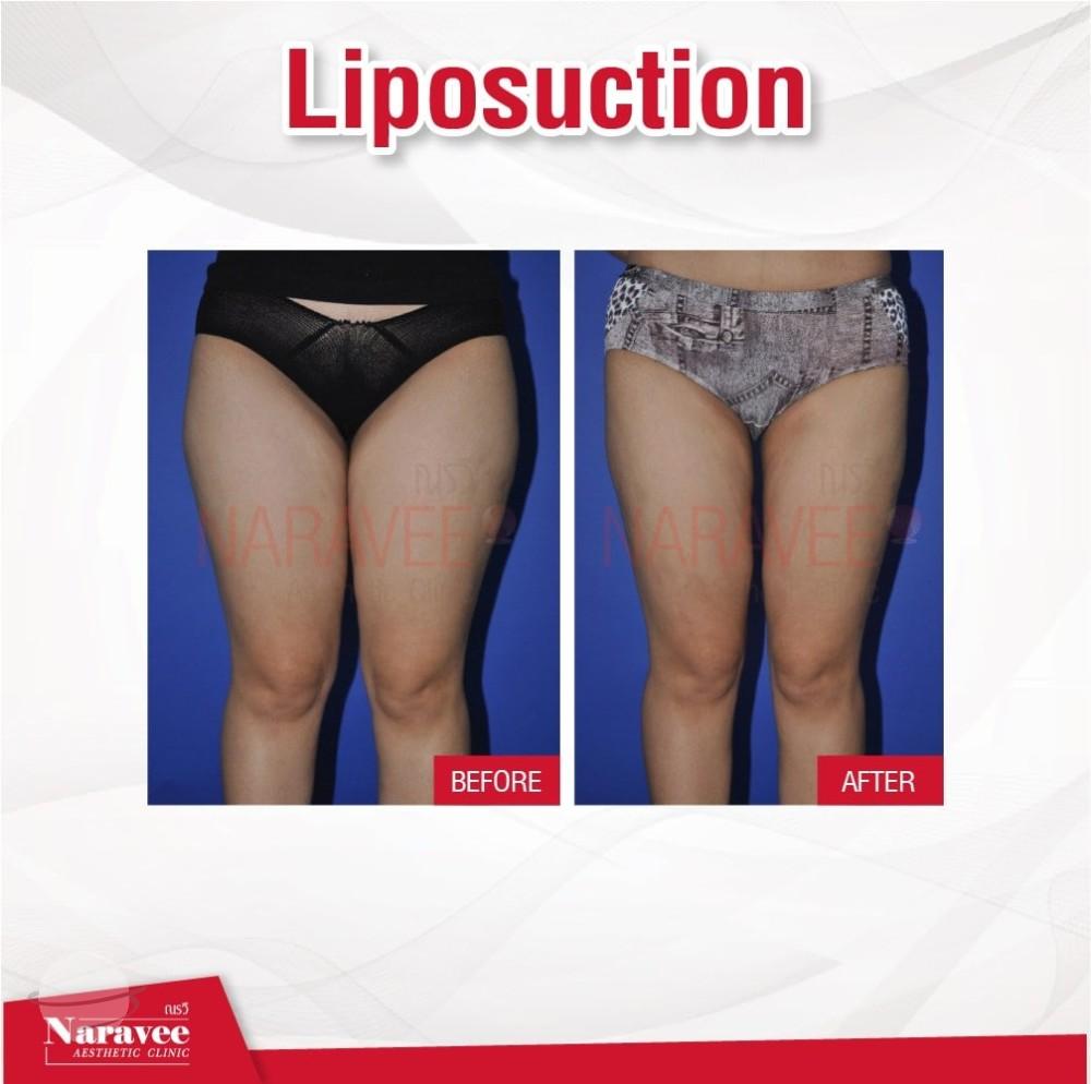 Risultato prima e dopo per Liposuzione — Naravee Clinic