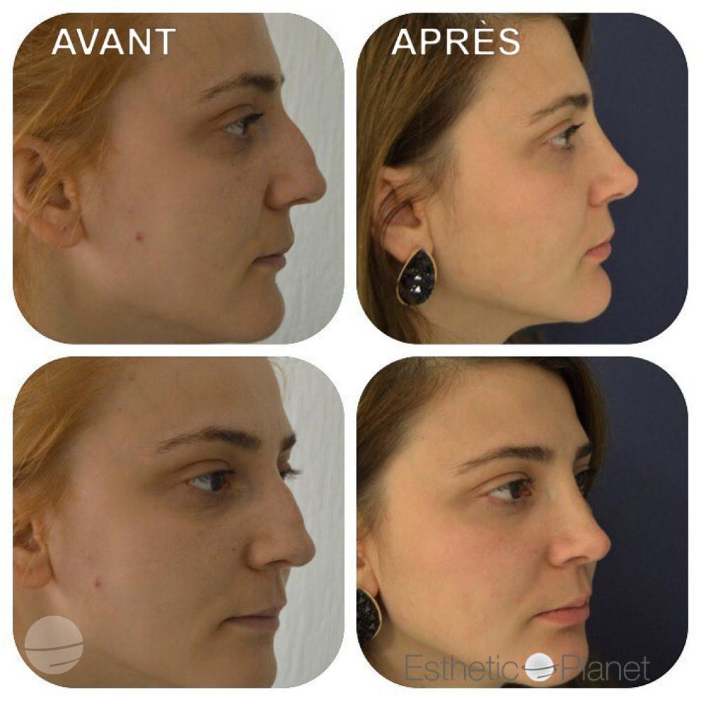 Rhinoplastie by Dr Ergin Er