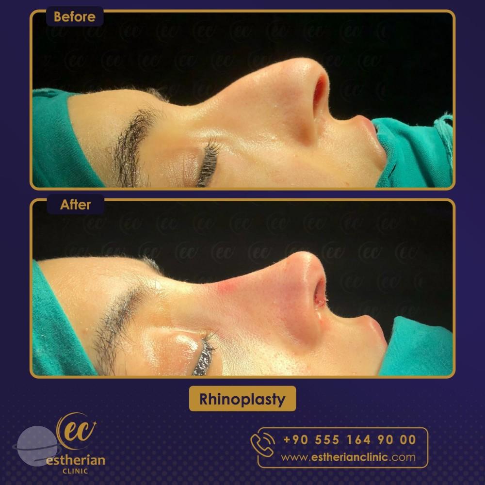 Resultado de antes y después para Rinoplastia clásica — Estherian clinic