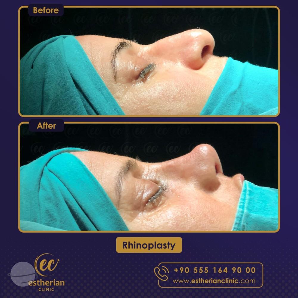 Risultato prima e dopo per Rinoplastica Classica — Estherian clinic