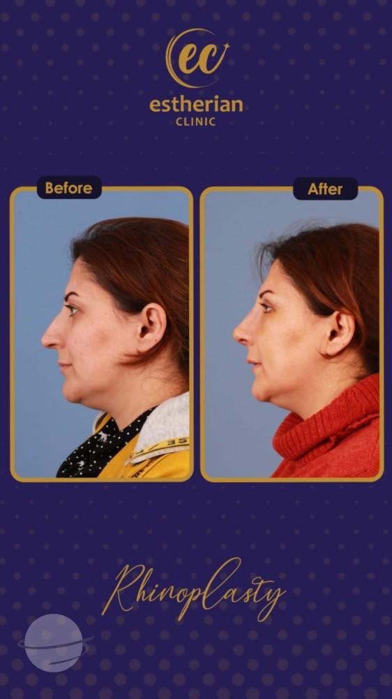Resultado de antes y después para Rinoplastia clásica — Estherian clinic