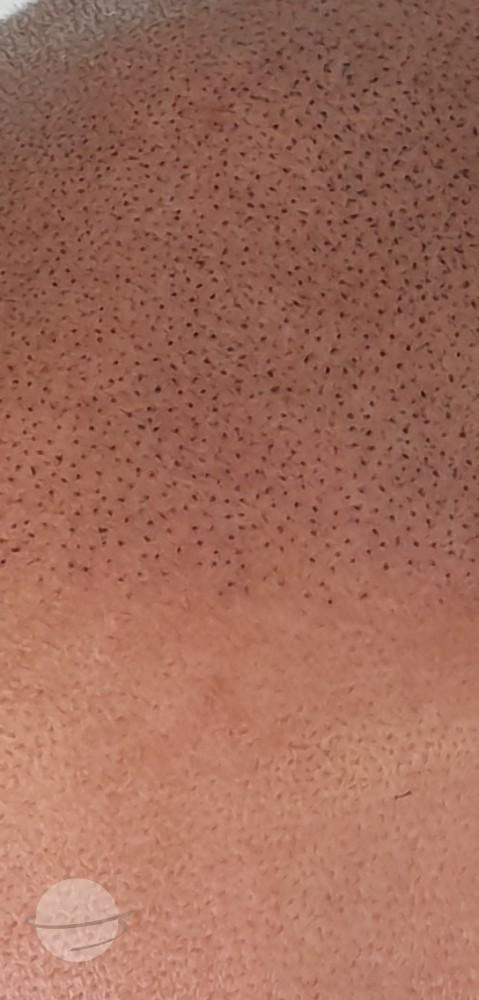 Scalp Micro Pigmentation result close up 