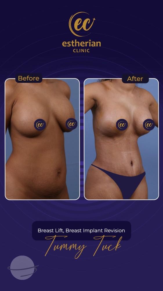 Risultato prima e dopo per Mommy Makeover — Estherian clinic