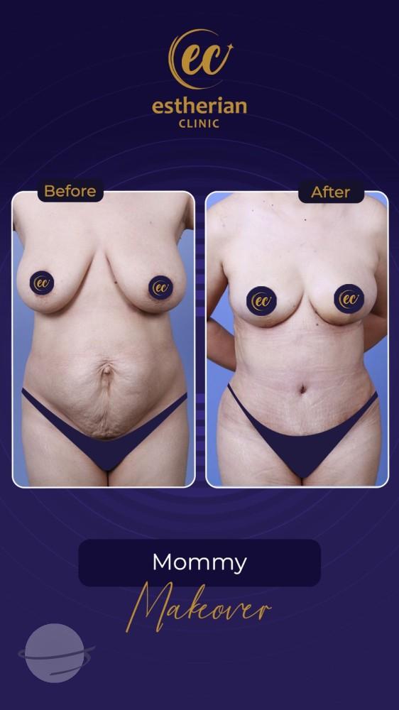 Risultato prima e dopo per Mommy Makeover — Estherian clinic