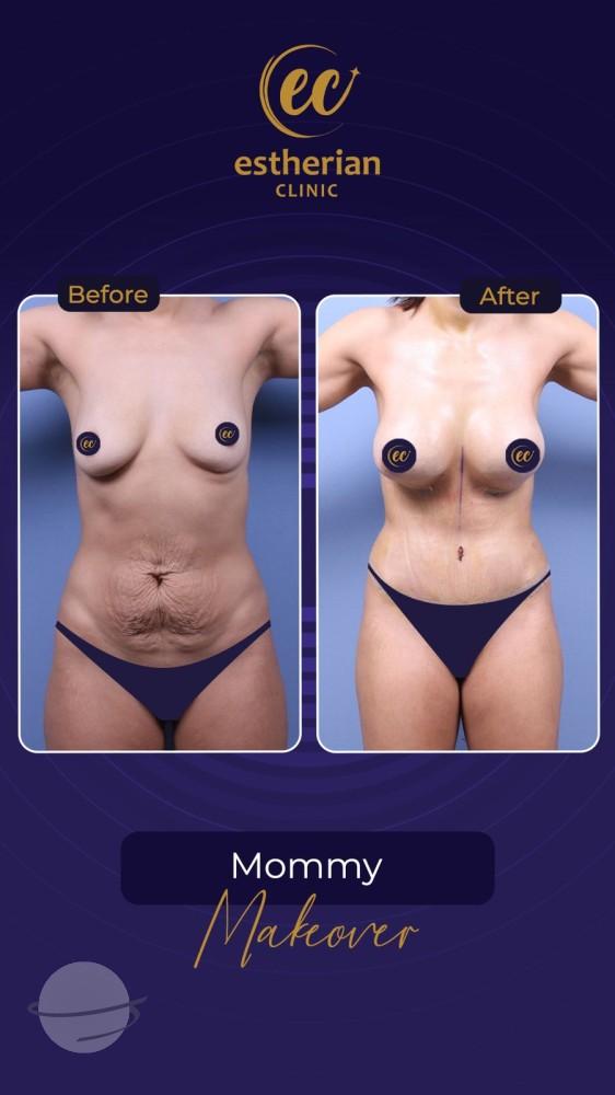 Resultado de antes y después para Cirugía estética posparto — Estherian clinic