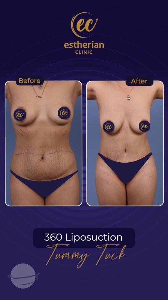 Resultado de antes y después para Cirugía estética posparto — Estherian clinic
